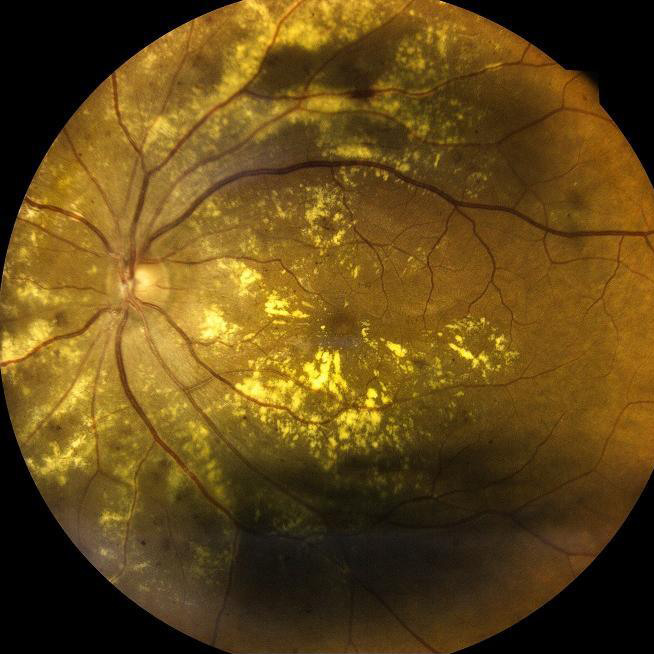 Nuevo paso hacia la curación de la ceguera causada por la diabetes y de la degeneración macular asociada a la edad 