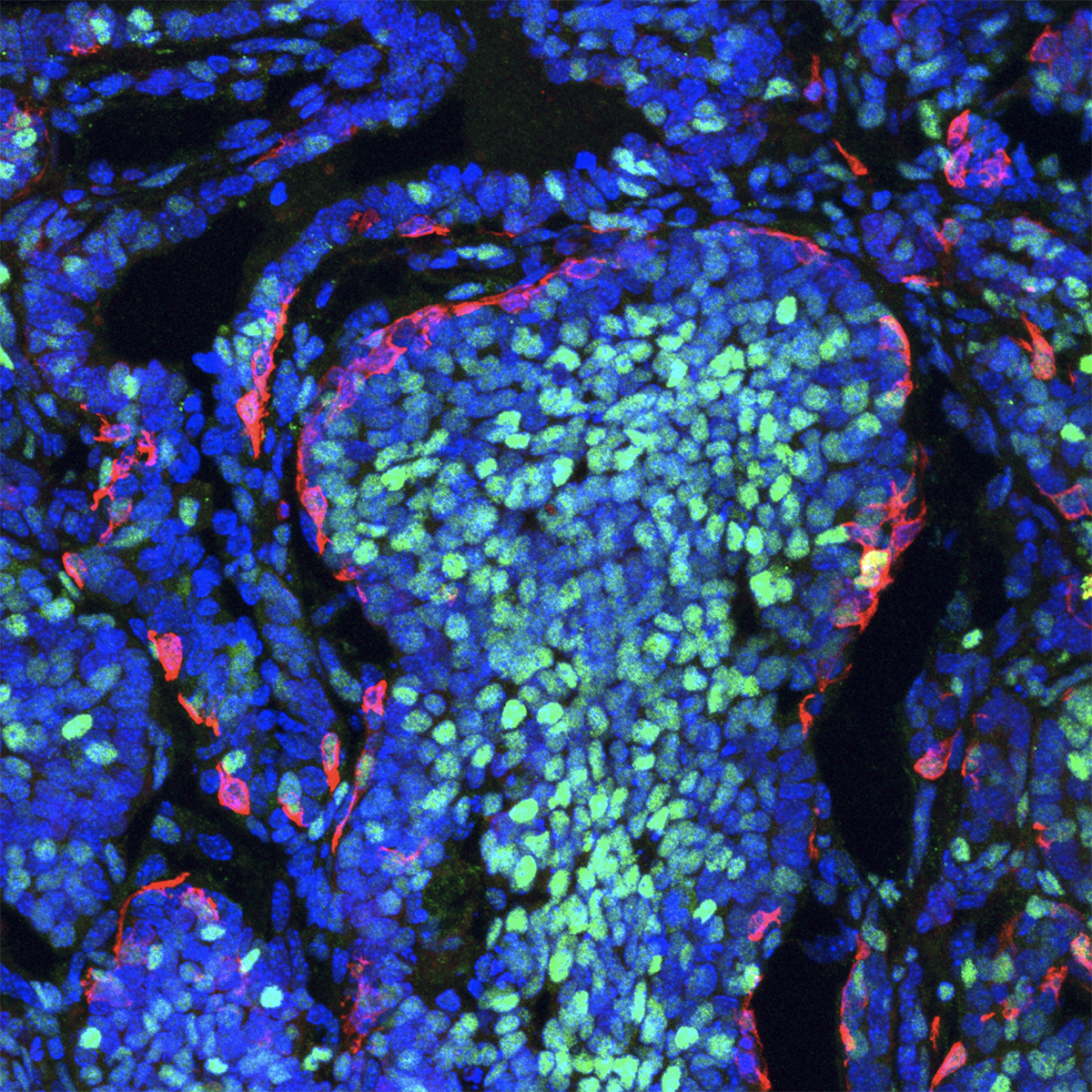 Un estudio revela que las células cancerosas compiten a favor y en contra del desarrollo del tumor