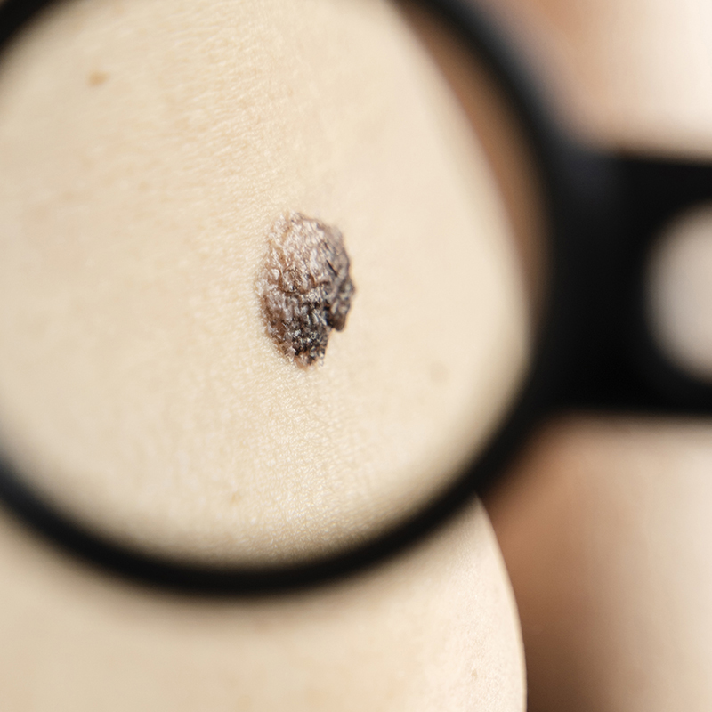 Nuevas nanopartículas inteligentes capaces de eliminar células tumorales y frenar el crecimiento del melanoma