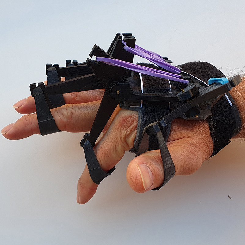 Una ortesis basada en IA e impresión 3D mejora la vida de personas con lesiones que dificultan o impiden abrir la mano